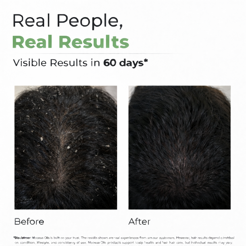 Anti-Dandruff Oil